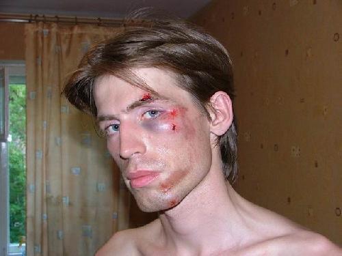 Как сделать синяк на лице в домашних условиях Как сделать синяк на лице в домашних условиях