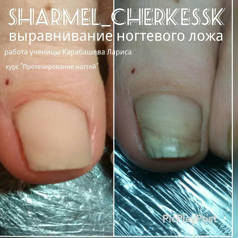Заговор при врастающем ногтей Заговор при врастающем ногтей