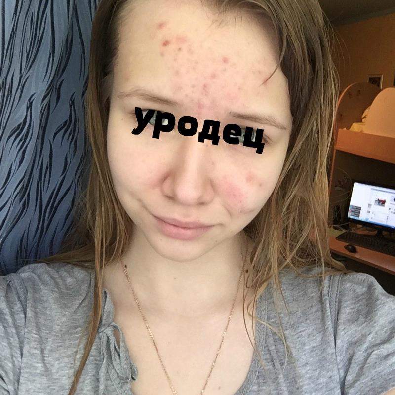 Что такое орви клиника лечение у детей