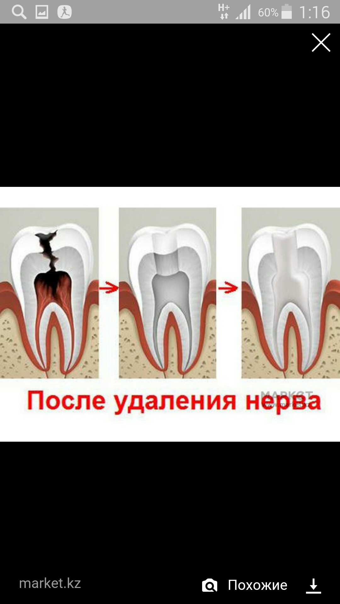 Как узнать удалять нерв в зубе Как узнать удалять нерв в зубе