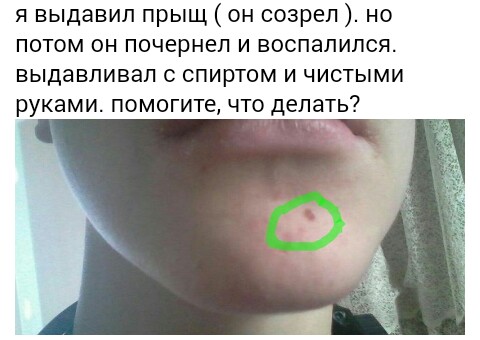 Что сделать если выдавила прыщ Что сделать если выдавила прыщ
