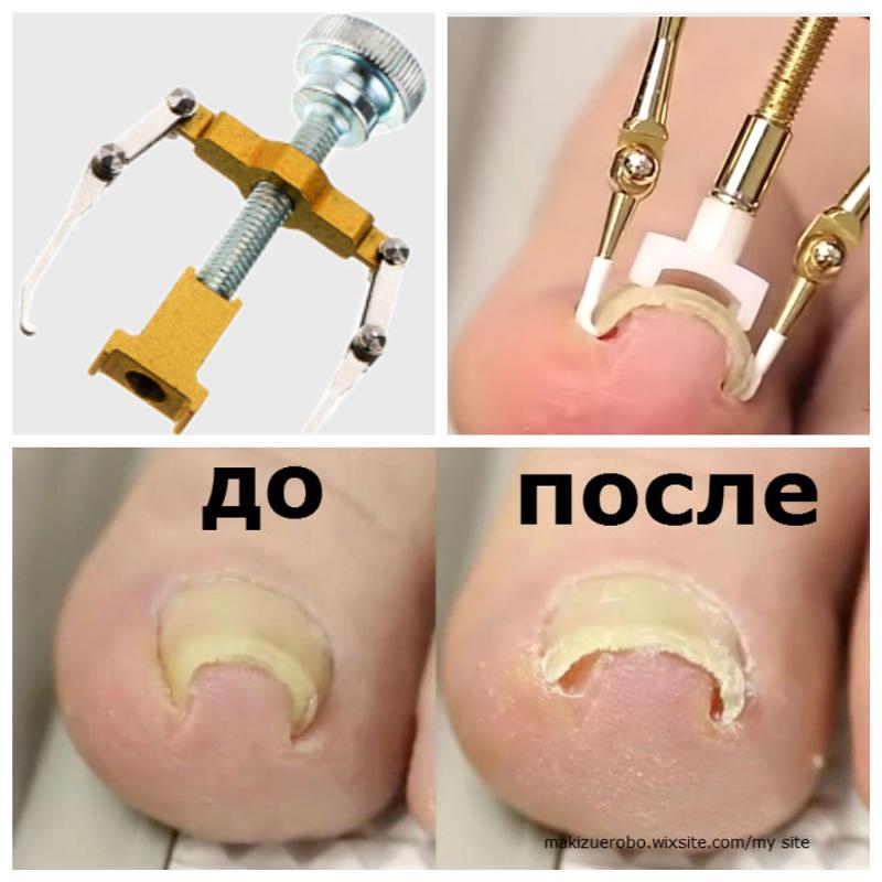 Лечение нагноений в домашних условиях Лечение нагноений в домашних условиях