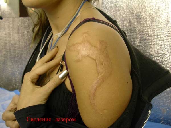 Как свести тату в домашних