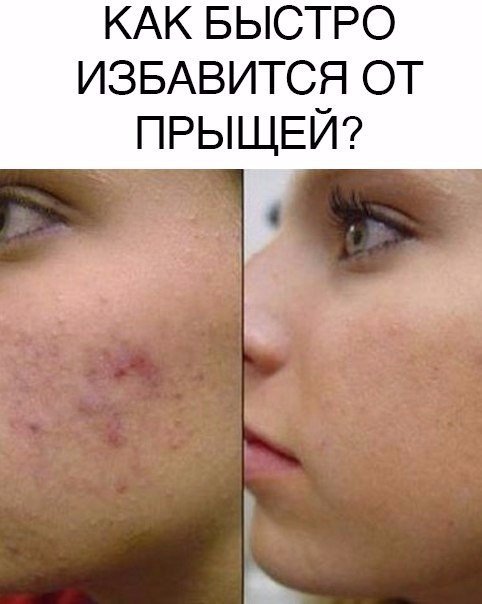 Домашние условия избавится от прыщей за неделю Домашние условия избавится от прыщей за неделю
