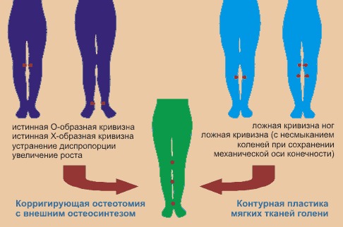 Что носить при искривлении ног у Что носить при искривлении ног у