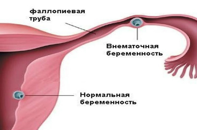 Гарднерелла при беременности, лечение гарднереллы во время Выделения первой неделе беременности после зачатия. Первая 1 неделя