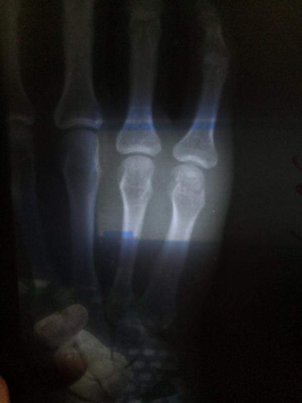 Перелом Безымянного Пальца Ноги Фото – Telegraph