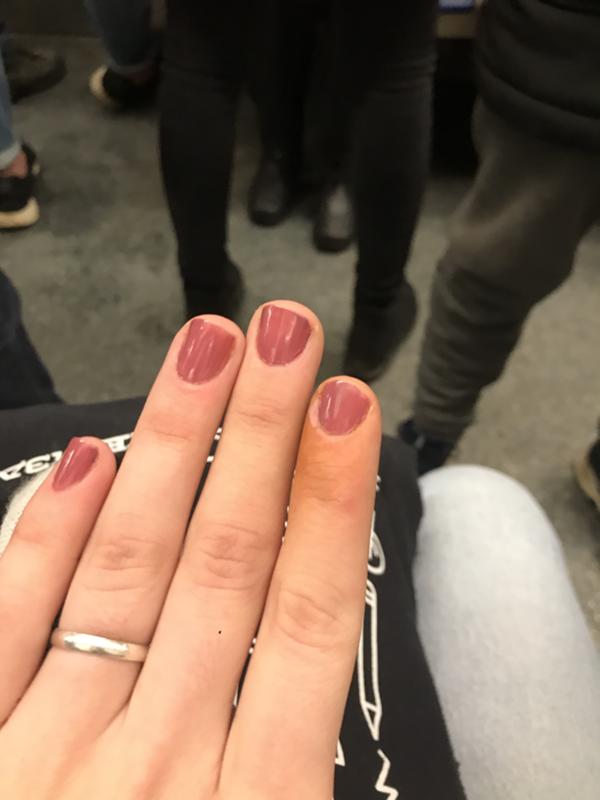 желтеют пальцы левой руки. указательный палец желтеет почему. коричневые пятна на подушечках пальцев. коричневые пятна на подушечках пальцев. вибрационная болезнь синдром рейно.