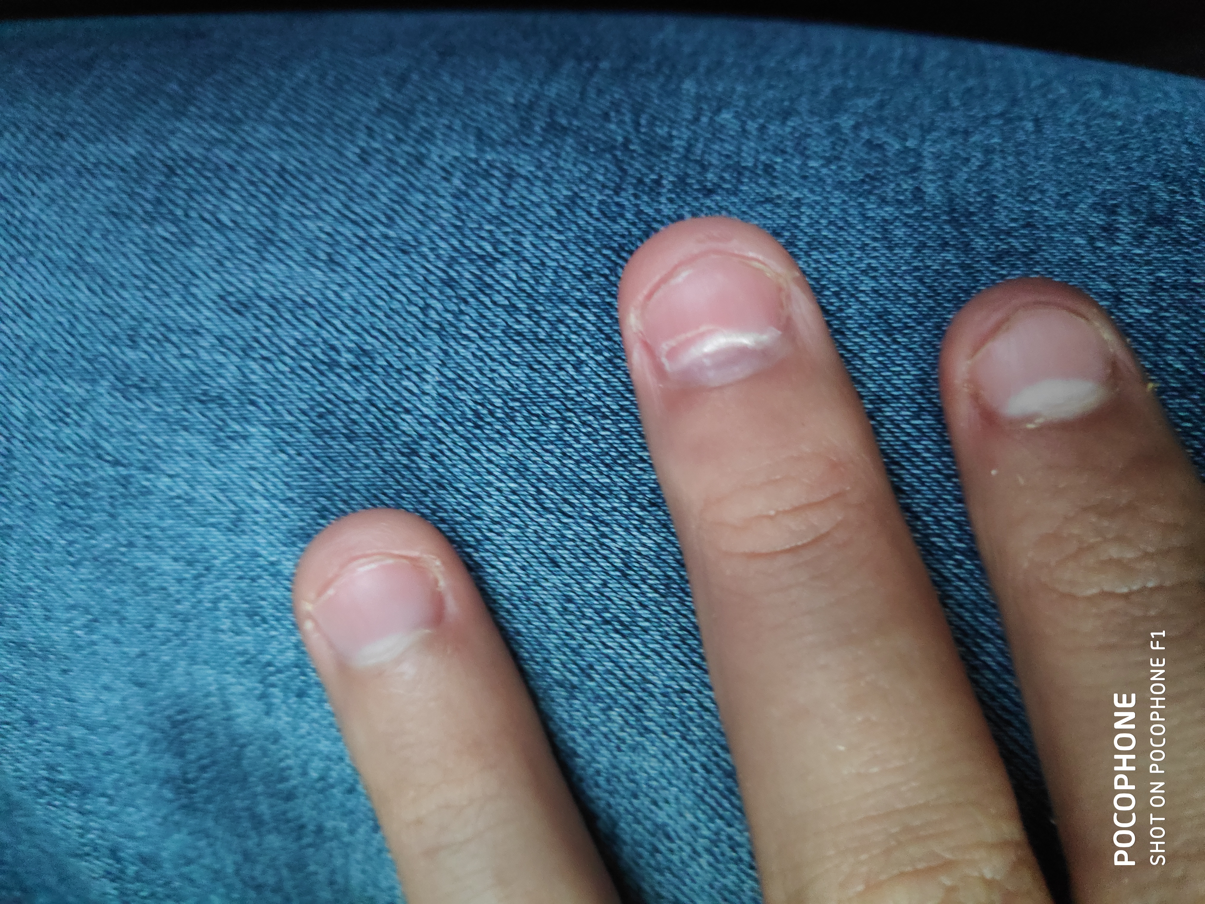 Онихошизис ногтевой пластины. Онихолизис на большом пальце руки. Ноготь отходит от ногтевого ложа. Кожа отошла от ногтя возле кутикулы. Отхождение ногтя от кожи.