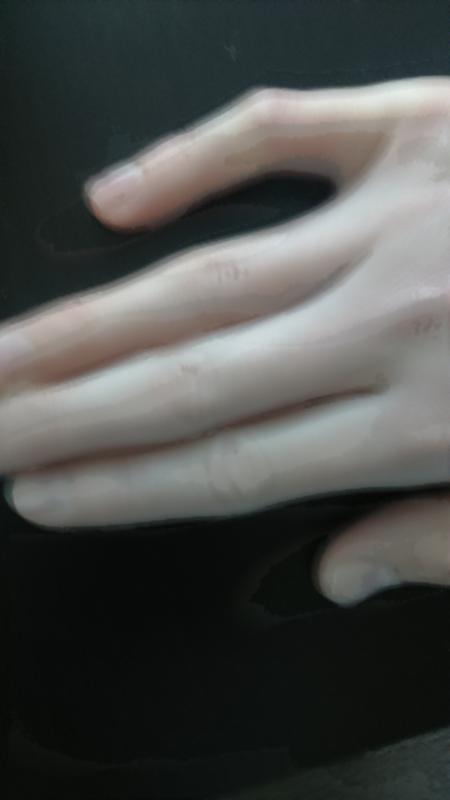 на сгибе указательного пальца. шишка на сгибе пальца руки. шишка на сгибе указательного пальца. стенозирующий лигаментит пальца. сустав указательного пальца.