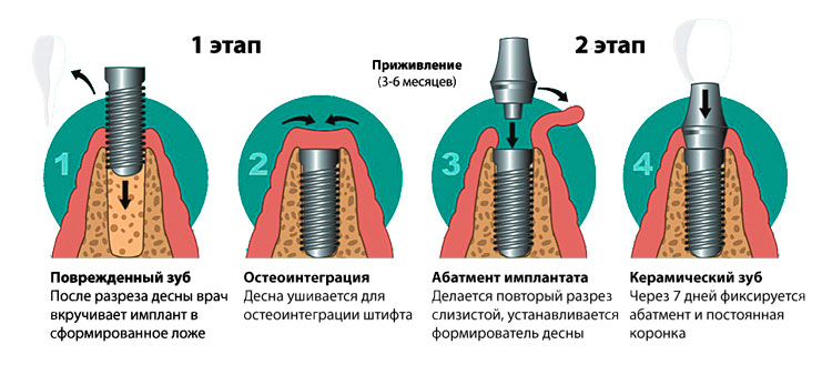 Что Такое Имплант Фото