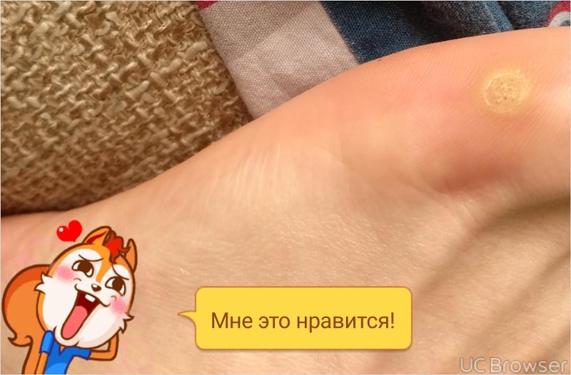 Мозоль Куриная Жопа Фото Мозоль Куриная Жопа Фото