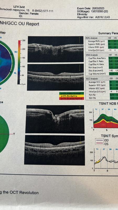 оптическая когерентная томография дзн расшифровка. оптическая когерентная томография диска зрительного нерва. окт результаты. оптическая когерентная томография сетчатки. оптическая когерентная томография норма и патология.
