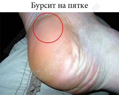 Лечение пяточной шпоры морской солью