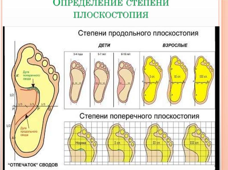 Поперечное плоскостопие фото лечение
