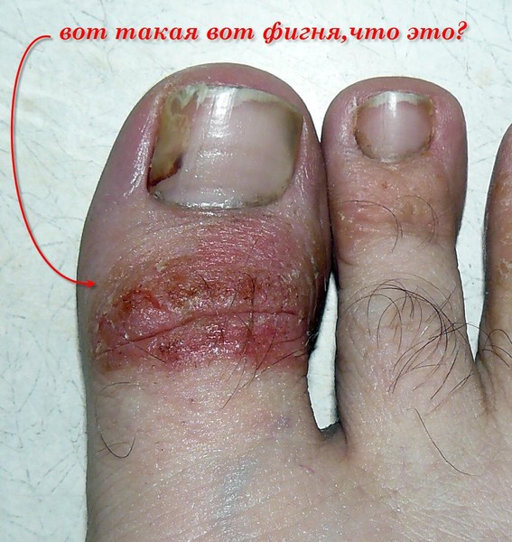 Народные средства от грибка на ногтях ног быстро