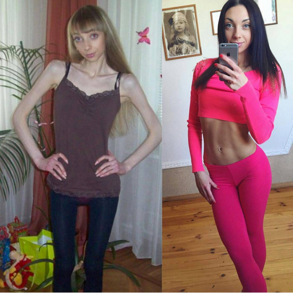 похудение до костей похудение до костей