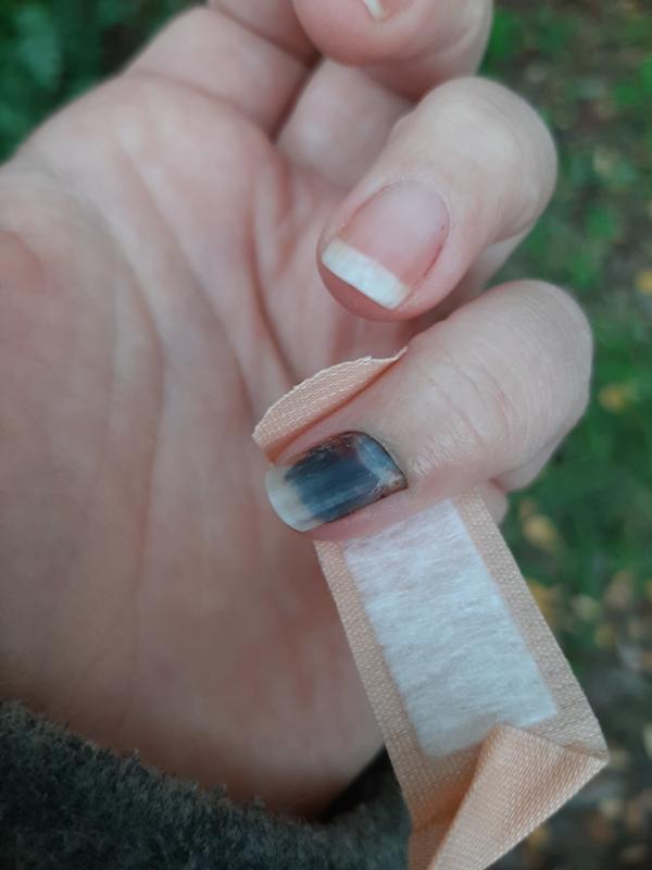 Ответы Mail.ru: Помогите! Прищемила очень сильно палец