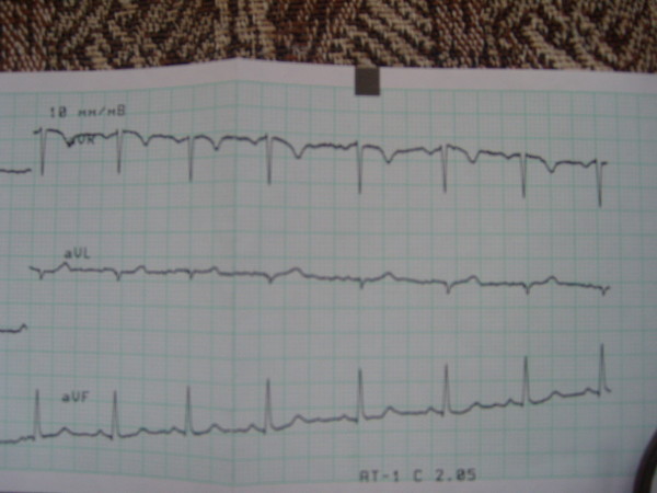 Плохое экг сердца у взрослого. Что значит плохое экг. Что значит плохое экг. Плохие результаты экг. Нормальные показатели при экг сердца.