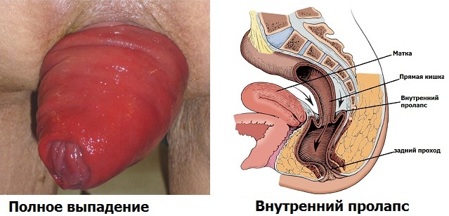 Геморрой выход кишки Геморрой выход кишки