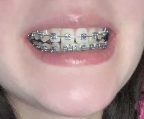 Исправление прикуса брекетами. Сколько стоят брекеты для детей 10 лет в россии. Установка брекетов детям. Можно по полису поставить брекеты. Можно по полису поставить брекеты.