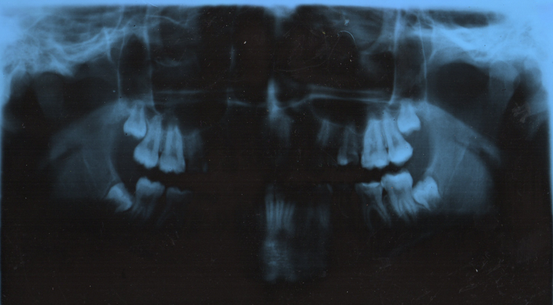 обязательно удалять зуб мудрости при брекетах