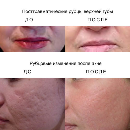 тыква от гельминтов тыква от гельминтов