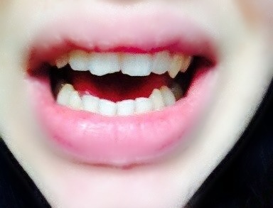 подпилить клыки